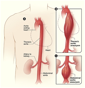 This image shows a normal aorta, and next to it shows a thoracic aortic aneurysm. It also shows an abdominal aortic aneurysm that is located below the arteries that supply blood to the kidneys.(Image courtesy of the National Heart, Lung, and Blood Institute)